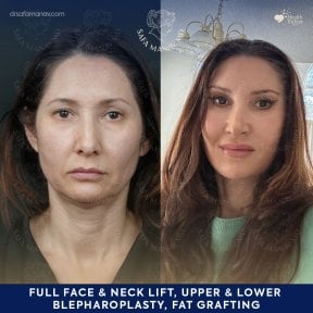 before-after photo facial-fat-transfer