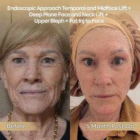 before-after photo facial-fat-transfer