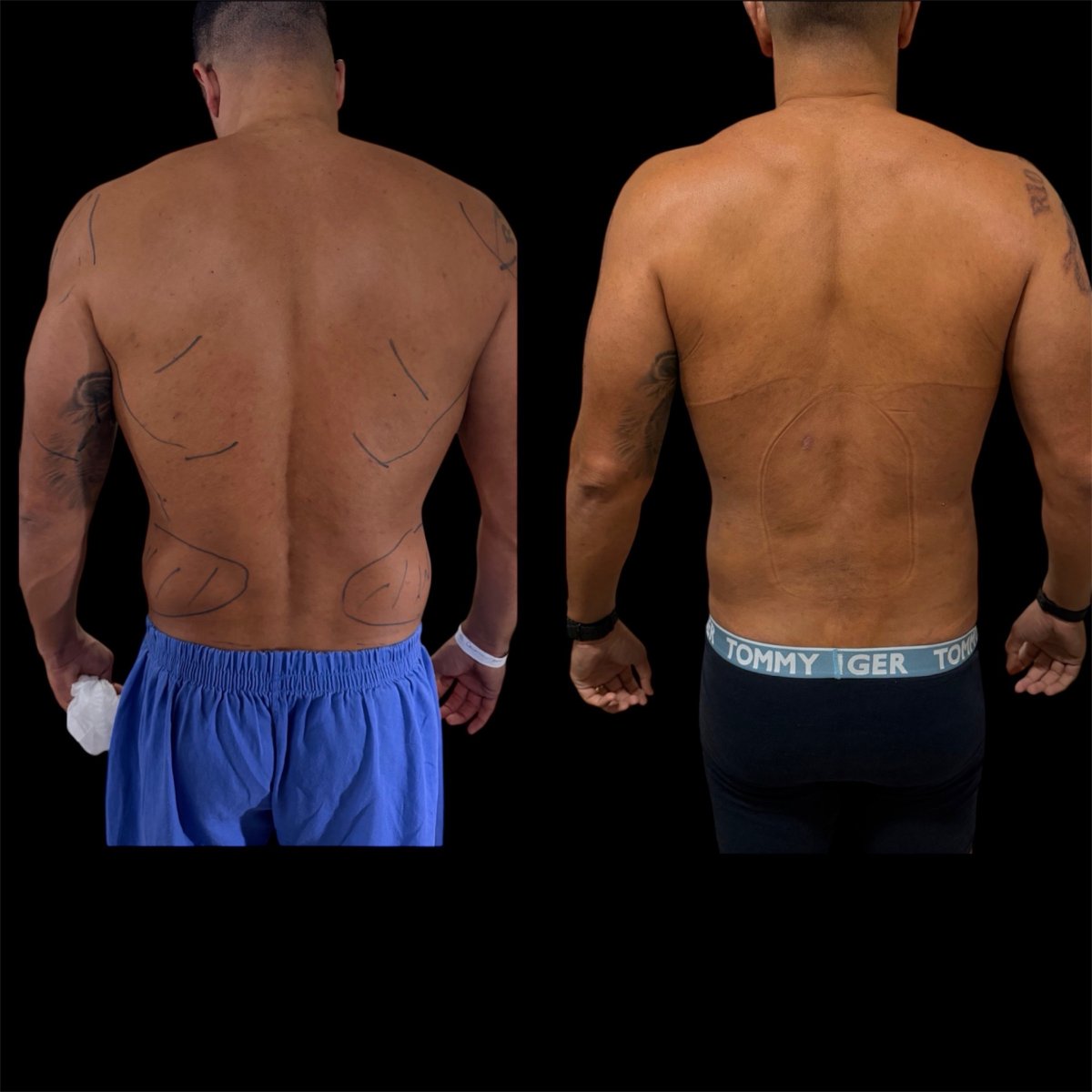 Resultados antes y después de liposucción 360 en Dr. Michel Salameh - Plastic And Aesthetic Surgery