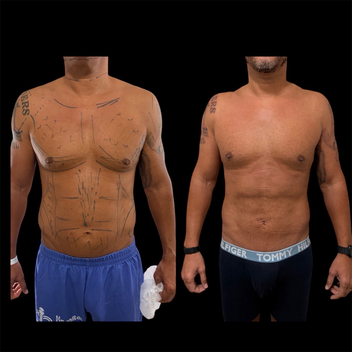 Resultado antes y después de liposucción 360 en Dr. Michel Salameh - Plastic And Aesthetic Surgery