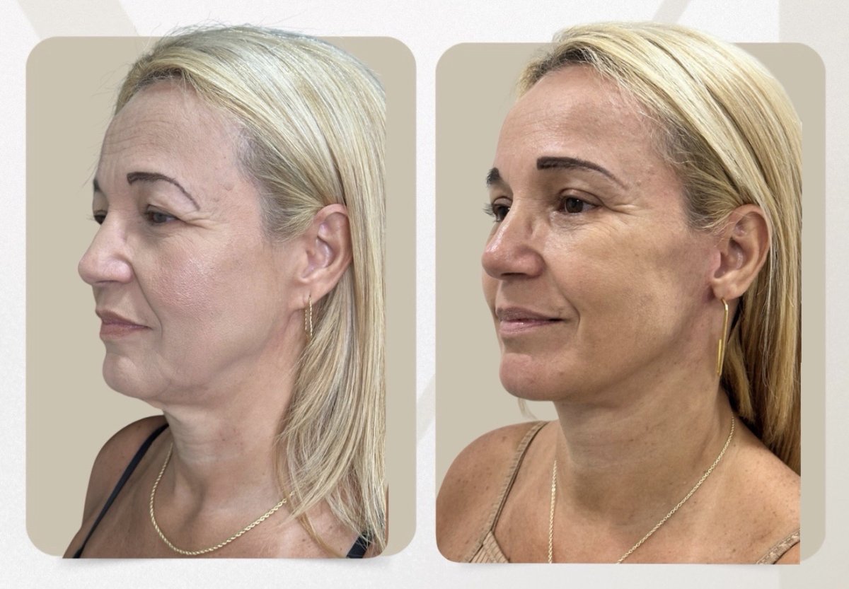 نتائج قبل وبعد شفط الدهون 360 في Dr. Michel Salameh - Plastic And Aesthetic Surgery