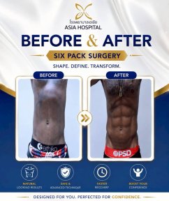 before-after photo abdominal-etching