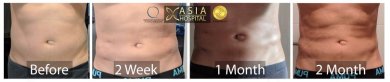 before-after photo abdominal-etching