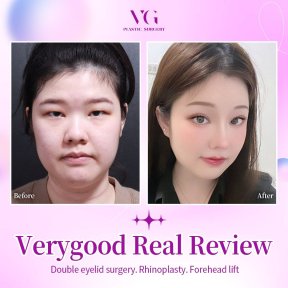 Before and after results of double eyelid surgery, rhinoplasty, and forehead lift at VG Plastic Surgery