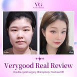 Before and after results of double eyelid surgery, rhinoplasty, and forehead lift at VG Plastic Surgery