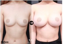 Before and after breast augmentation results at VG Plastic Surgery – enhanced breast volume