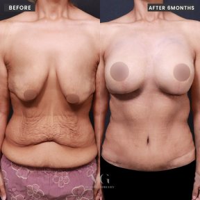 Résultats avant et après liposuccion chez VG Plastic Surgery, amélioration visible du contour corporel
