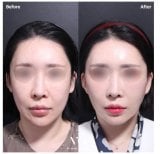 Efekty konturowania twarzy przed i po w VG Plastic Surgery – poprawiona symetria twarzy