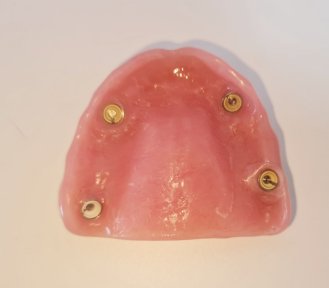 Implant-supported denture result at SoftDentalCare Clinic, upper jaw prosthesis shown