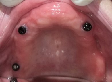 Upper jaw dental implants for denture placement at SoftDentalCare Clinic, treatment result