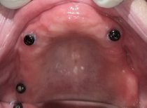 Upper jaw dental implants for denture placement at SoftDentalCare Clinic, treatment result