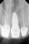 Dental implant X-ray result at SoftDentalCare Clinic showing successful tooth restoration