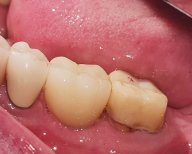 Dental implant result at SoftDentalCare Clinic, restored molar with natural appearance