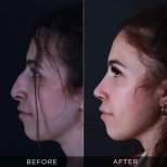 Resultados de rinoplastia antes y después en Dr. Hasan Duygulu Private Practice, remodelación nasal