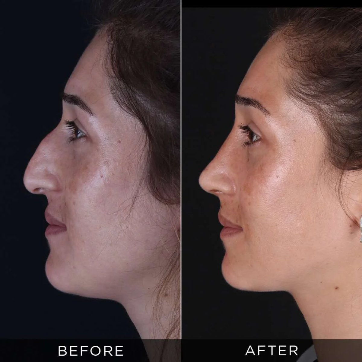 Resultados de rinoplastia antes y después en Dr. Hasan Duygulu Private Practice, remodelación nasal
