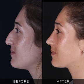 Resultados de rinoplastia antes y después en Dr. Hasan Duygulu Private Practice, remodelación nasal