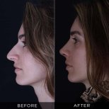 Resultados de rinoplastia antes y después en Dr. Hasan Duygulu Private Practice, remodelación nasal