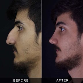 Resultados de rinoplastia antes y después en Dr. Hasan Duygulu, perfil nasal mejorado