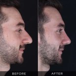 Resultados de rinoplastia antes y después en Dr. Hasan Duygulu, perfil nasal mejorado