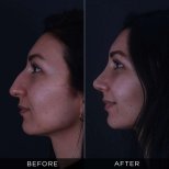 Resultados de rinoplastia antes y después en Dr. Hasan Duygulu Private Practice, remodelación nasal