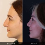 Resultados de rinoplastia antes y después en Dr. Hasan Duygulu Private Practice, remodelación nasal