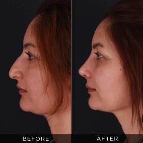 Resultados de rinoplastia antes y después en Dr. Hasan Duygulu, perfil nasal mejorado