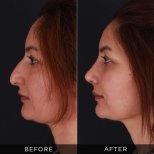 Resultados de rinoplastia antes y después en Dr. Hasan Duygulu, perfil nasal mejorado