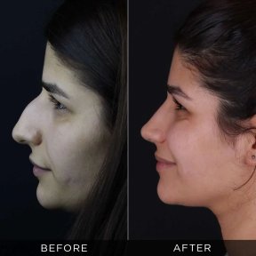 Resultados de rinoplastia antes y después en Dr. Hasan Duygulu Private Practice, remodelación nasal