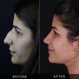 Resultados de rinoplastia antes y después en Dr. Hasan Duygulu Private Practice, remodelación nasal
