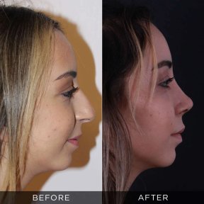 Resultados de rinoplastia antes y después en Dr. Hasan Duygulu Private Practice, remodelación nasal
