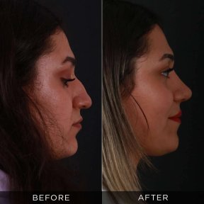 Resultados de rinoplastia antes y después en Dr. Hasan Duygulu Private Practice, remodelación nasal