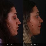 Resultados de rinoplastia antes y después en Dr. Hasan Duygulu Private Practice, remodelación nasal