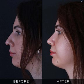 Resultados de rinoplastia antes y después en Dr. Hasan Duygulu, perfil nasal mejorado