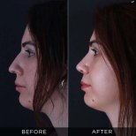 Resultados de rinoplastia antes y después en Dr. Hasan Duygulu, perfil nasal mejorado