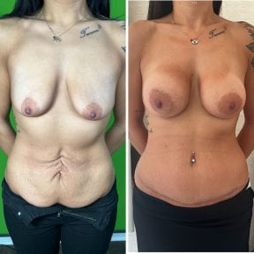 Before and after breast augmentation and tummy tuck at Prof. Dr. Furkan Karabekmez Clinic result