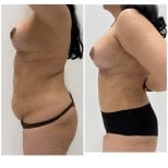 Before and after tummy tuck and breast lift results at Prof. Dr. Furkan Karabekmez Clinic Ankara