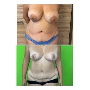 Before and after tummy tuck and breast lift results at Prof. Dr. Furkan Karabekmez Clinic Ankara