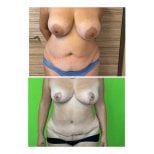 Before and after tummy tuck and breast lift results at Prof. Dr. Furkan Karabekmez Clinic Ankara