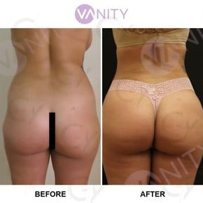 Результати до і після бразильської підтяжки сідниць у Vanity Cosmetic Surgery Center