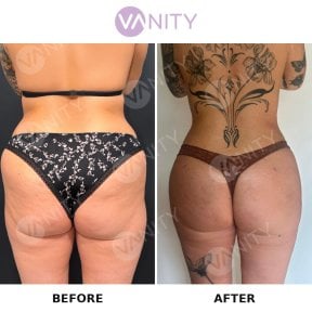 Результати до і після бразильської підтяжки сідниць у Vanity Cosmetic Surgery Center