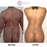 Результати до і після Brazilian Butt Lift у Vanity Cosmetic Surgery Center, контур тіла