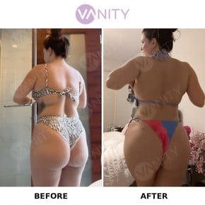 Результати до і після Brazilian Butt Lift у Vanity Cosmetic Surgery Center, покращені форми