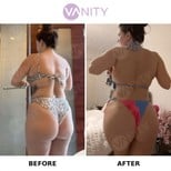 Результати до і після Brazilian Butt Lift у Vanity Cosmetic Surgery Center, покращені форми
