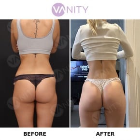 نتائج قبل وبعد عملية شد المؤخرة البرازيلية في Vanity Cosmetic Surgery Center
