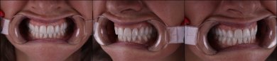 Smile transformation with dental veneers at RIKOTA Dental Clinic – natural-looking results