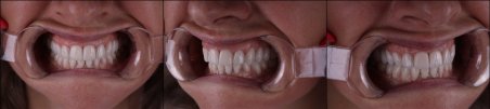 Smile transformation with dental veneers at RIKOTA Dental Clinic – natural-looking results