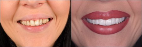 Before and after dental veneers at RIKOTA Dental Clinic – smile transformation results