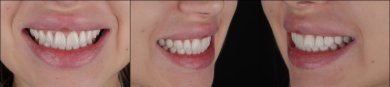 Smile transformation with dental veneers at RIKOTA Dental Clinic – natural looking results