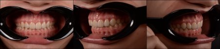 Before and after veneers at RIKOTA Dental Clinic – improved smile aesthetics and alignment result