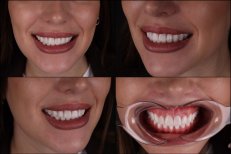 Smile transformation with dental veneers at RIKOTA Dental Clinic, natural-looking results